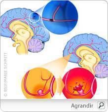 accident_vasculaire_cerebral_pm