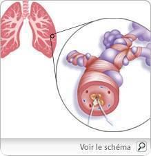 Asthme