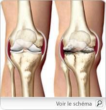 arthrose_pm