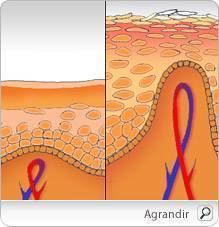 psoriasis_pm