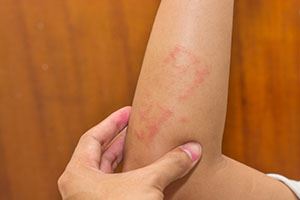 Eczéma, les bons réflexes pour l’éviter