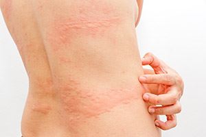 10 symptômes révélateurs d’une allergie