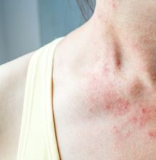 eczema_pm